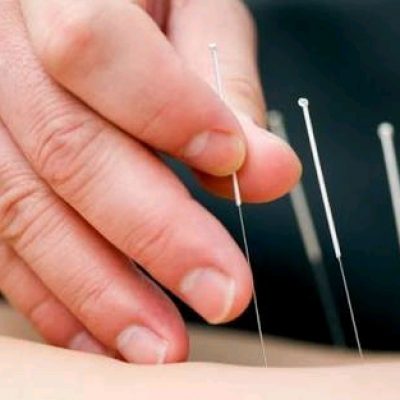 Registered acupuncturist- 15 years acupuncture clinic